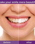 Teeth Whitening