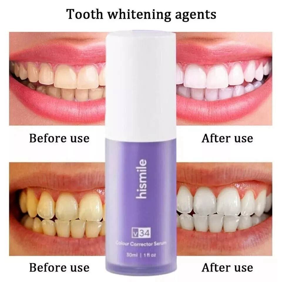 Teeth Whitening